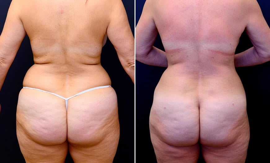 LIPOSUCTION RESULTS