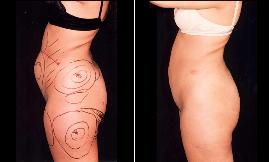 LIPOSUCTION RESULTS