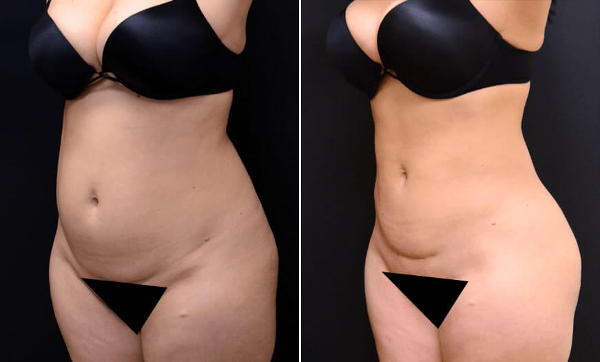 LIPOSUCTION RESULTS