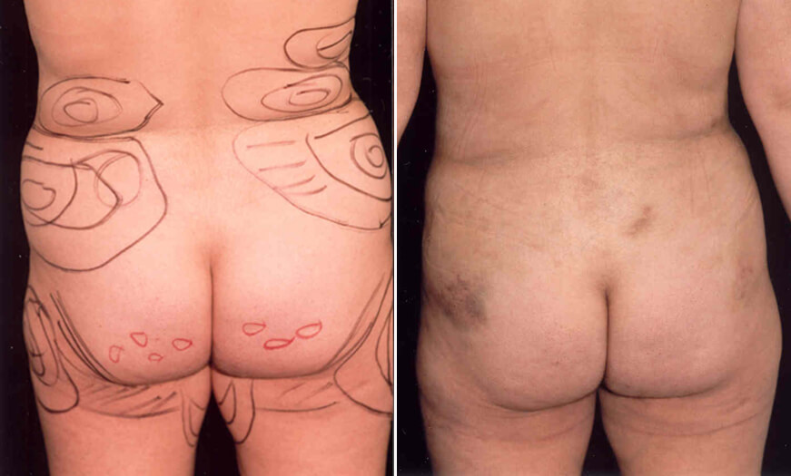 LIPOSUCTION RESULTS