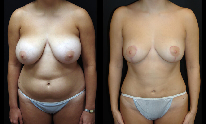 LIPOSUCTION RESULTS