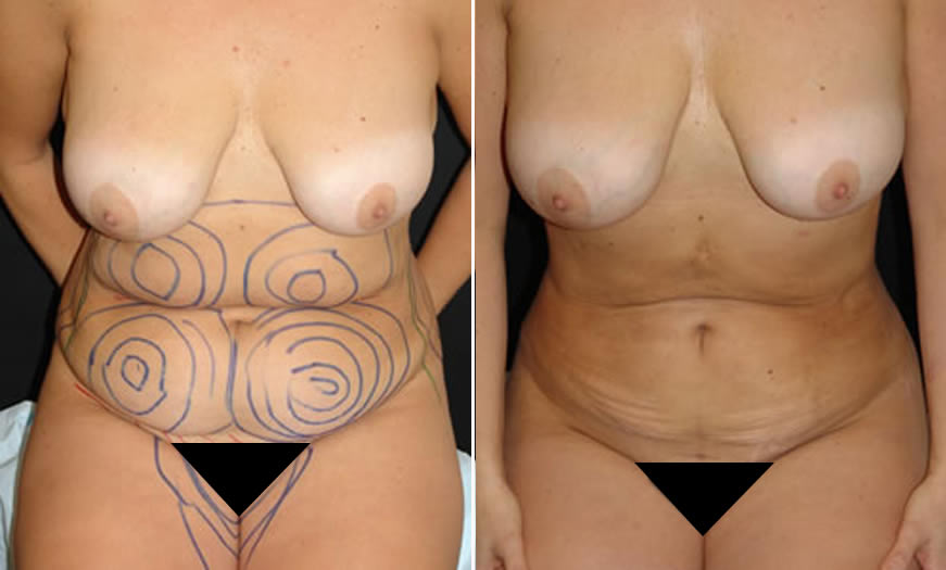LIPOSUCTION RESULTS